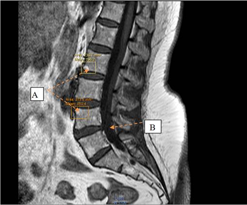 osteophyte formation lumbar spine